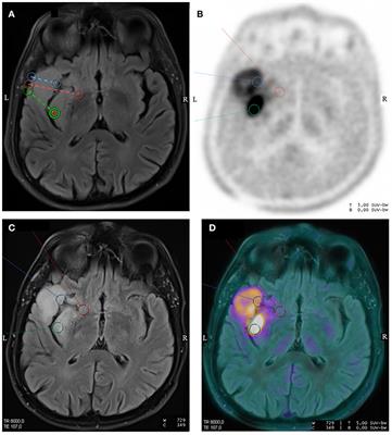 Additive Value of Dynamic FDOPA PET/CT for Glioma Grading